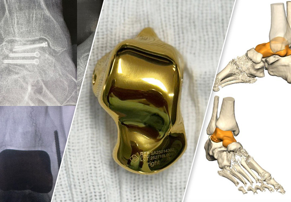 Cirurgia inovadora com prótese total de tálus personalizada